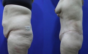 46 Year Old Treated for Abdominal Apron & Sagging Buttocks before 1109105