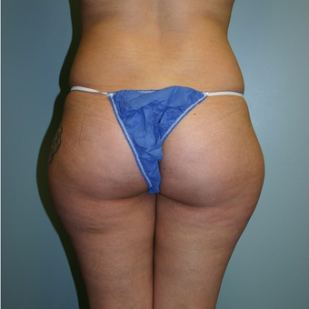 Brazilian Butt Lift before 3667536