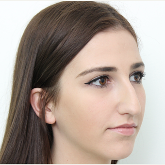 18-24 year old woman treated with Rhinoplasty before 3366744