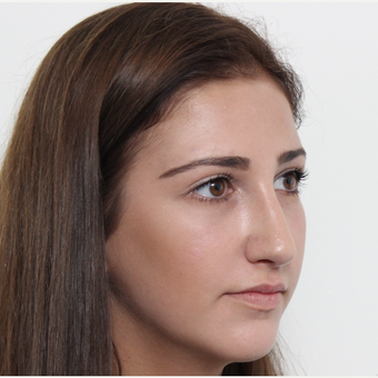 18-24 year old woman treated with Rhinoplasty after 3366744