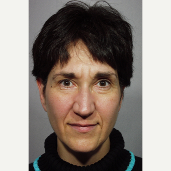 48 year old woman treated with Forehead Lift before 3324935
