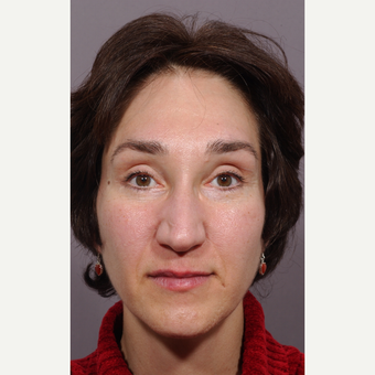 48 year old woman treated with Forehead Lift after 3324935