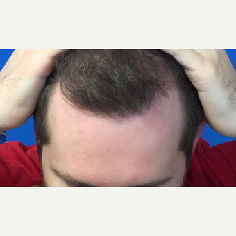 25-34 year old man treated with Hair Transplant after 3102674