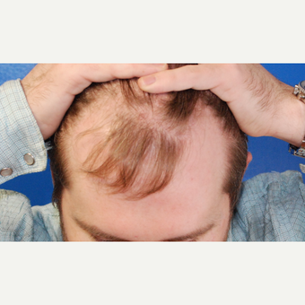 25-34 year old man treated with Hair Transplant before 3102674