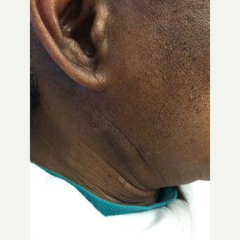 Scar / Keloid Treatment after 1689795