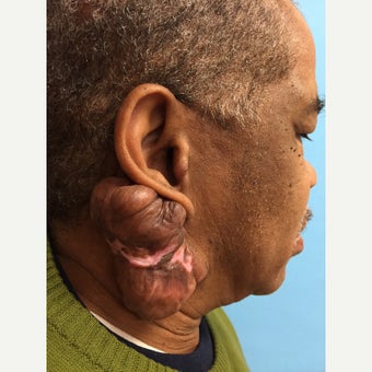 Scar / Keloid Treatment before 1689795