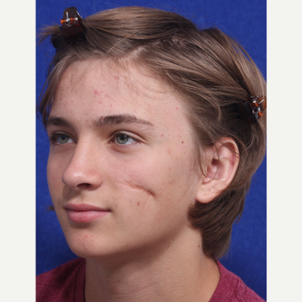 17 or under year old man treated with Scar Removal before 3047523