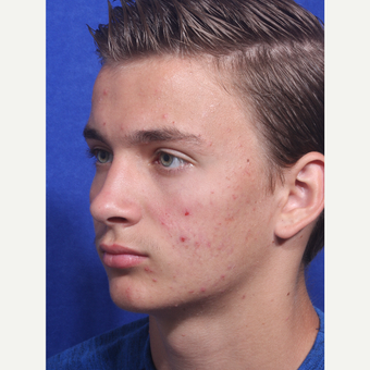 17 or under year old man treated with Scar Removal after 3047523