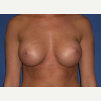 25-34 year old woman treated with Breast Augmentation after 3220025