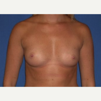25-34 year old woman treated with Breast Augmentation before 3220025