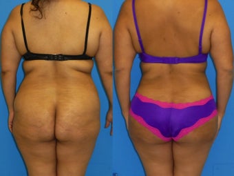 33 Year Old Female underwent Liposuction of full midsection, back, and flanks + BBL (Fat transfer to buttocks) after 1128645