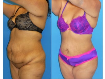 33 Year Old Female underwent Liposuction of full midsection, back, and flanks + BBL (Fat transfer to buttocks) 1128645