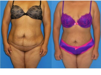 33 Year Old Female underwent Liposuction of full midsection, back, and flanks + BBL (Fat transfer to buttocks) before 1128645