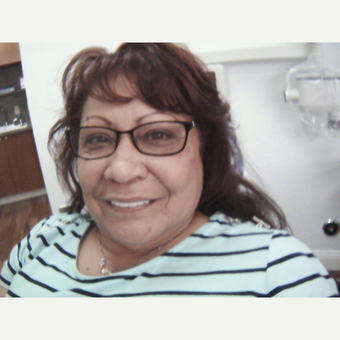 55-64 year old woman treated with Smile Makeover after 3659833