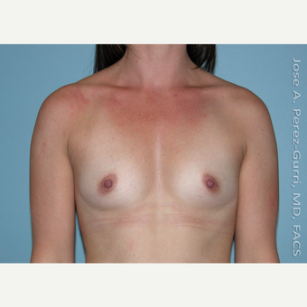 25-34 year old woman treated with Breast Augmentation before 2994654