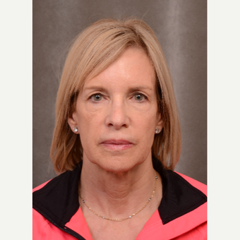 63 year old woman treated with Facelift before 3530135
