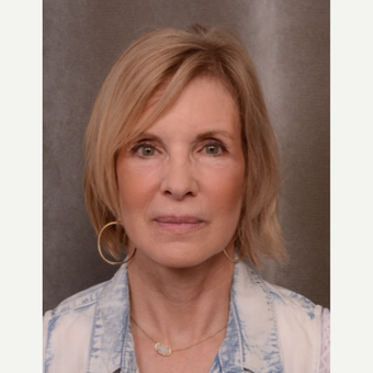 63 year old woman treated with Facelift after 3530135
