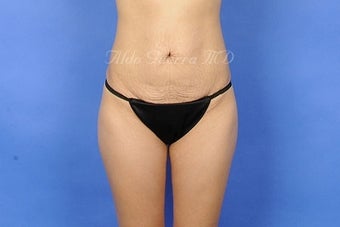 33 Year Old Female Tummy Tuck with Lipo before 975125