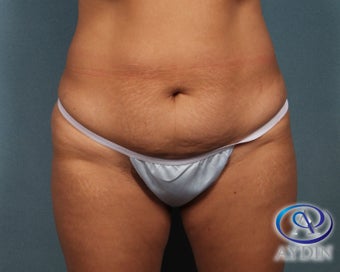35-44 year old woman treated with Tummy Tuck before 3325822