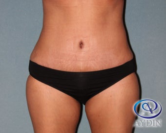 35-44 year old woman treated with Tummy Tuck after 3325822