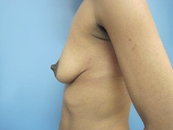 25-34 year old woman treated with Breast Augmentation 2834719