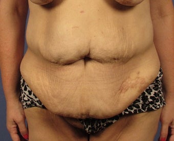 45-54 year old woman treated with Tummy Tuck before 3095899