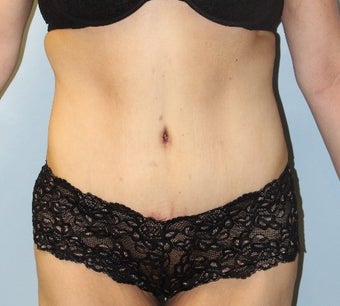 45-54 year old woman treated with Tummy Tuck after 3095899