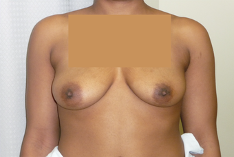 Mini UBL with no implants before 1089207