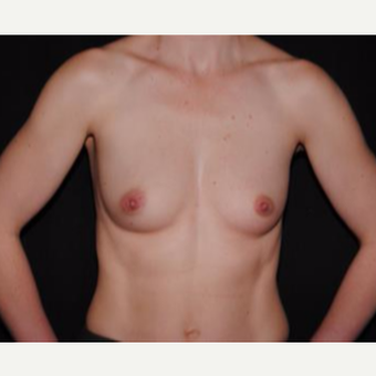 25-34 year old woman treated with Breast Implants before 3593666