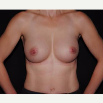 25-34 year old woman treated with Breast Implants after 3593666