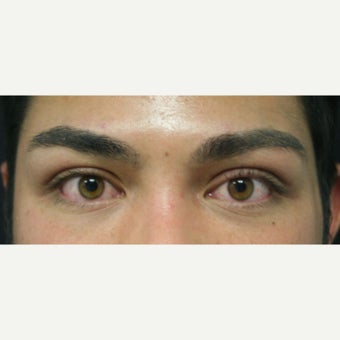 18-24 year old man treated with Eyelid Surgery after 2077866
