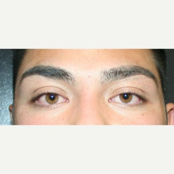 18-24 year old man treated with Eyelid Surgery before 2077866