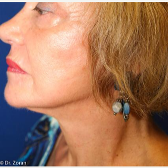 65-74 year old woman treated with Facelift after 3093476