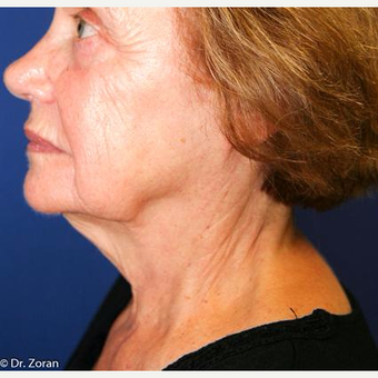 65-74 year old woman treated with Facelift before 3093476