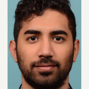 25-34 year old man treated with Rhinoplasty after 3064751