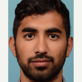 25-34 year old man treated with Rhinoplasty before 3064751