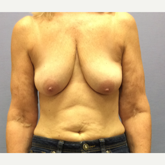 55-64 year old woman treated with Breast Lift with Implants before 3169702