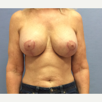 55-64 year old woman treated with Breast Lift with Implants after 3169702
