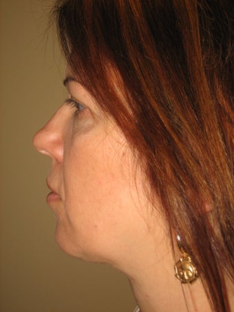 45 year old female before and after SmartLipo of the neck after 626269