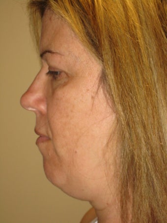 45 year old female before and after SmartLipo of the neck before 626269
