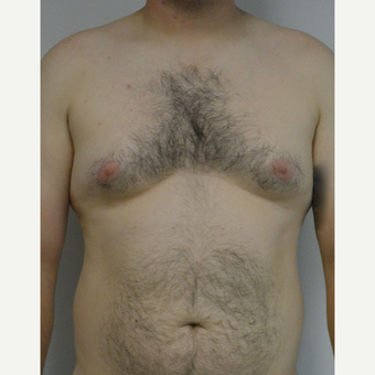 25-34 year old man treated with Male Breast Reduction before 3175391