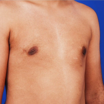 18-24 year old man treated with Vaser Gynecomastia Surgery - Male Breast Reduction after 3741566