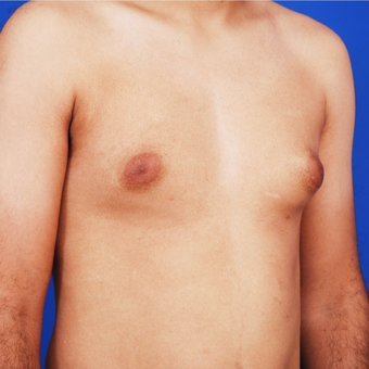 18-24 year old man treated with Vaser Gynecomastia Surgery - Male Breast Reduction before 3741566