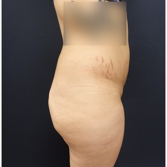25-34 year old woman treated with 548cc Silicone Butt Implants and 600cc of fat transfer. before 2854213