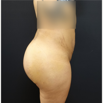 25-34 year old woman treated with 548cc Silicone Butt Implants and 600cc of fat transfer. after 2854213