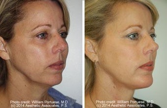 Neck Lift, Neck Lipo, Chin Implant before 212306