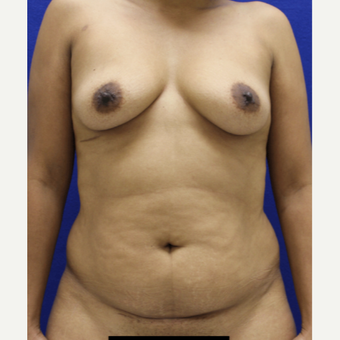 25-34 year old woman treated with Mommy Makeover before 3482463