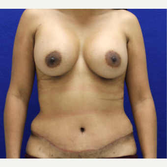 25-34 year old woman treated with Mommy Makeover after 3482463