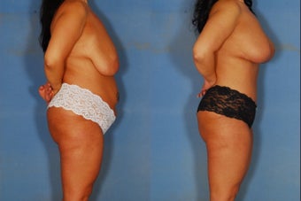 Tummy tuck, liposuction, and breast lift before 381906