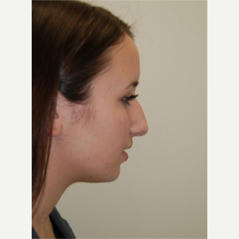 18-24 year old woman treated with Rhinoplasty before 3143511